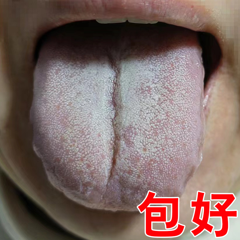 舌头裂痕地图舌裂纹舌齿痕灼口综合症舌头发白发厚麻木起泡抑菌液