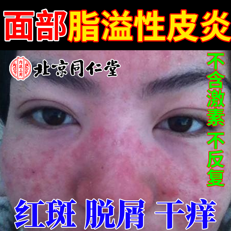 脂溢性皮炎面部鼻翼软膏溢脂性脸部过敏性脸上湿疹红斑瘙痒脱屑YS