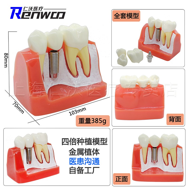 牙科种植模型 牙齿种植体模型 种C植牙模型 连冠 单冠 口腔教学