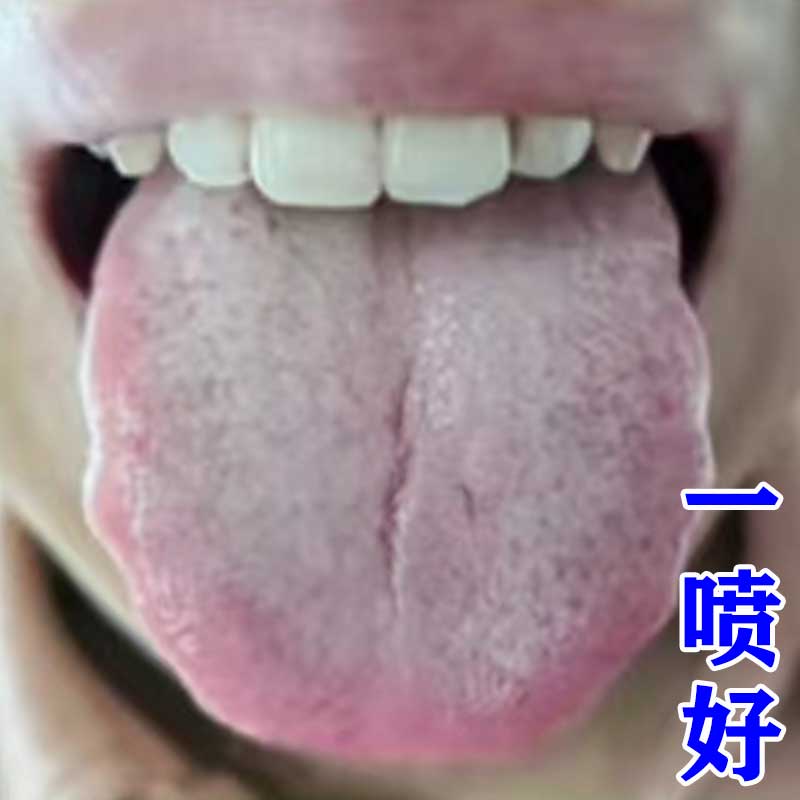 舌头裂痕地图舌裂纹舌齿痕舌发白发厚麻木起泡疼灼口综合症舌苔净