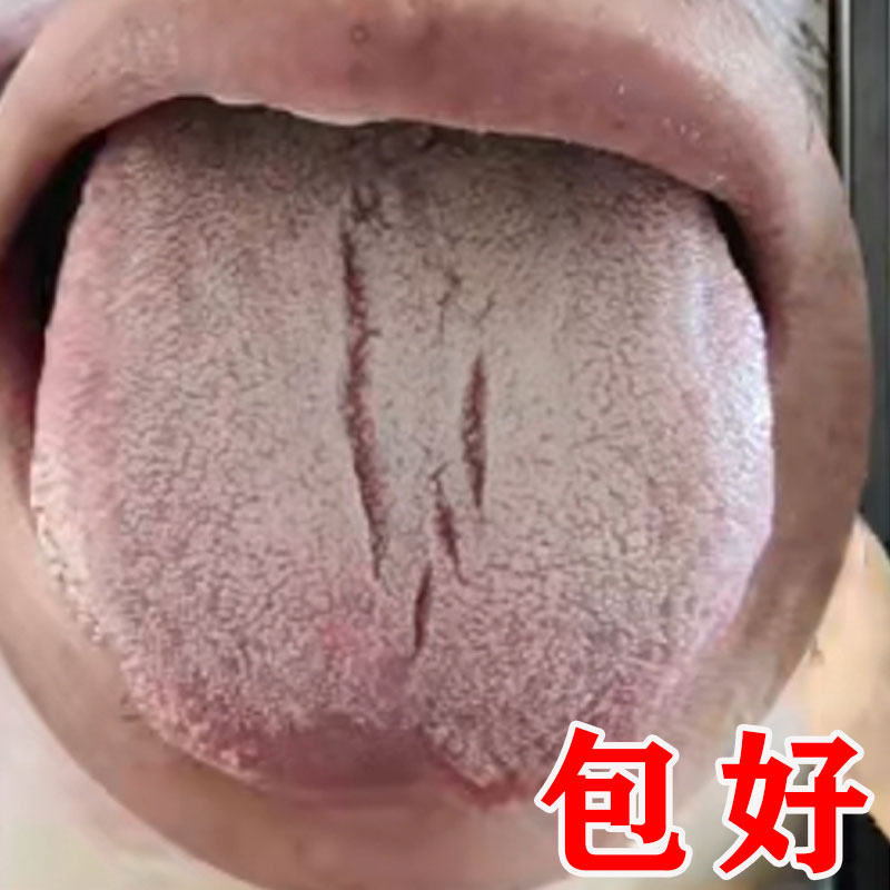 舌头裂痕地图舌裂纹舌齿痕舌头发白发厚麻木起泡疼灼口综合症喷剂