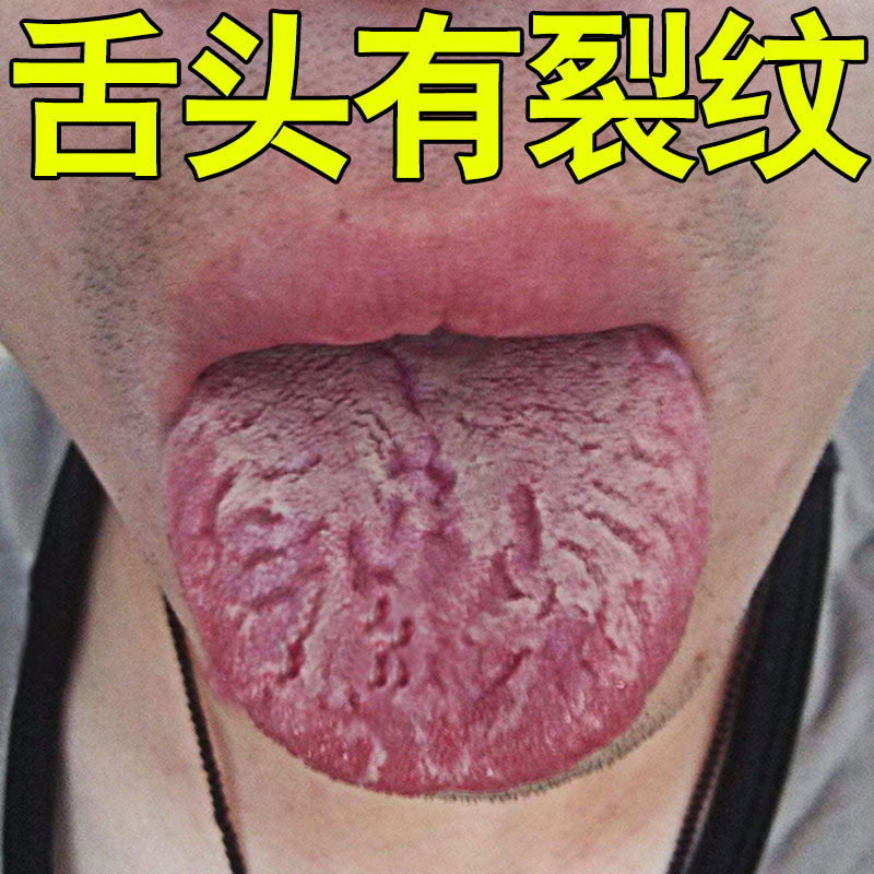 舌头裂痕地图舌裂纹舌齿痕灼口综合症舌头发白发厚麻木起泡特效剂