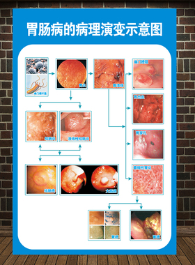 胃肠病的病理演变过程示意图医学挂图人体器官心脏结构图医院海报